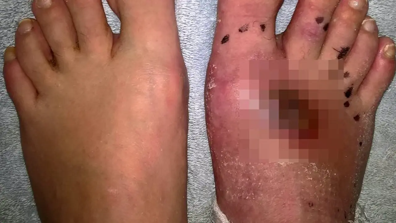 Ngeri, Setelah Digigit Laba-Laba Mematikan Kaki Wanita Diamputasi