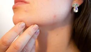 Cara Mengatasi Jerawat Hormonal di Area Rahang agar Tak Mudah Kambuh