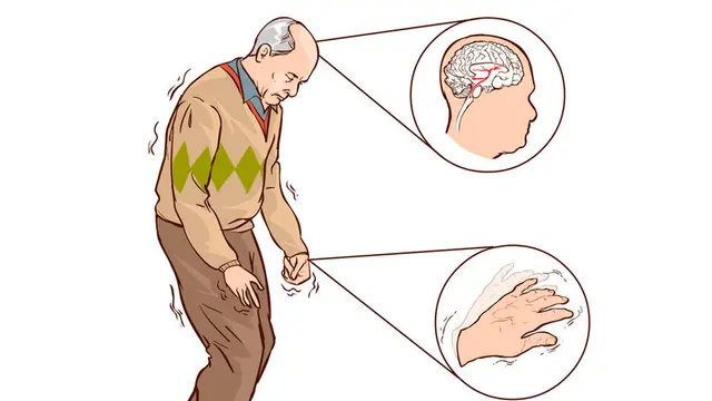 Studi Ungkap 2 Gejala Awal Baru Parkinson, Bikin Diagnosis Lebih Mudah