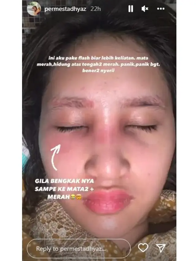 12 Foto Kronologi Dhyaz Anak Farida Nurhan Alami Infeksi Hidung hingga Angkat Implan