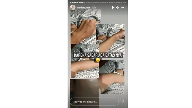 7 Potret Bukti KDRT Medina Zein oleh Suami, Bekas Luka Jadi Sorotan
