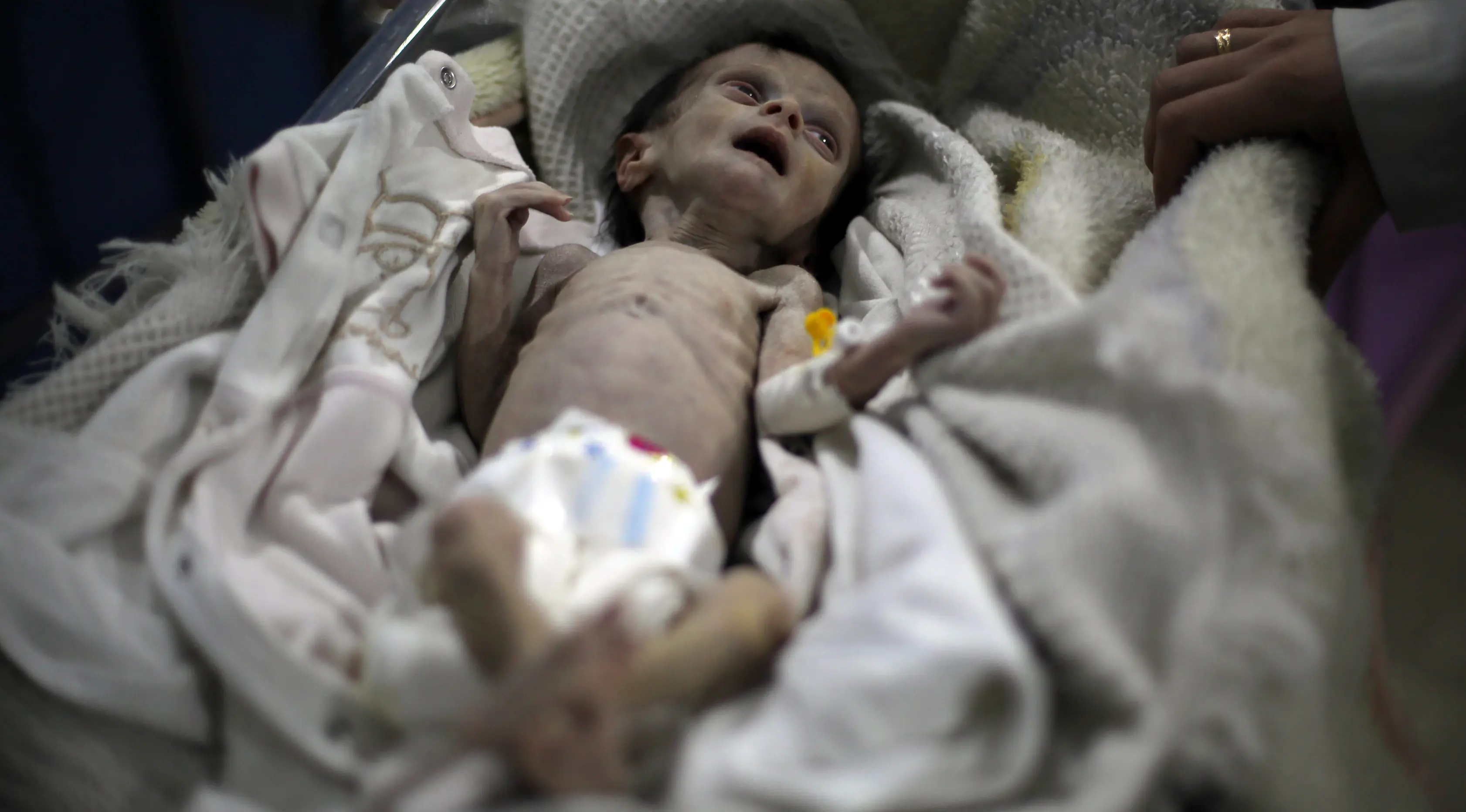 Sahar Dofdaa, bayi Suriah yang menderita kekurangan gizi parah di sebuah klinik pinggiran kota Damaskus, yang dikuasai oposisi, 21 Oktober 2017. Ibu bayi perempuan itu mengalami kekurangan gizi akut sehingga sulit untuk menyusui. (Amer ALMOHIBANY/AFP)