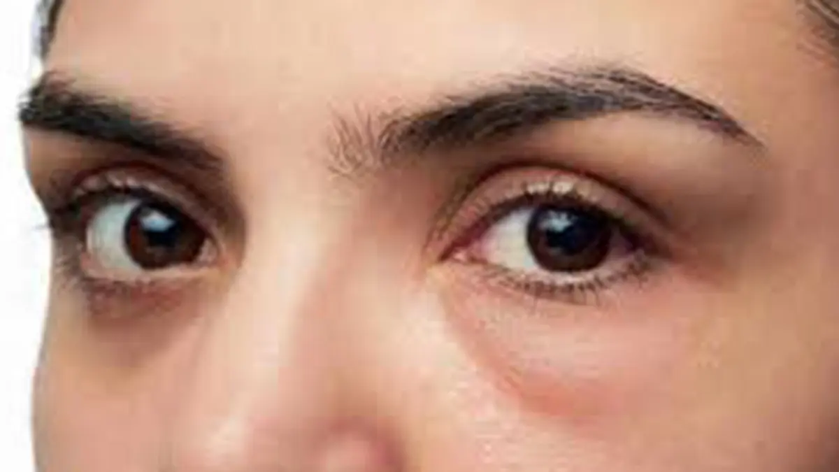 Cara menghilangkan kantung mata secara permanen