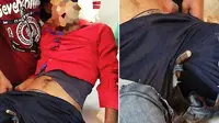 Seorang pria malang terpaksa menghadapi perjalanan memalukan dengan anusnya yang tertancap batangan besi menuju rumah sakit.