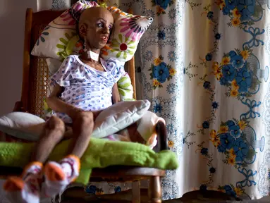 Magali Gonzalez Sierra bersiap merayakan ulang tahunnya ke-15 di El Cabuyal, Kolombia, 16 Januari 2016. Magali menderita progeria, kelainan genetik yang membuat tubuhnya cepat tua sehingga memiliki tubuh setara wanita berusia 90 tahun. (AFP/LUIS ROBAYO)