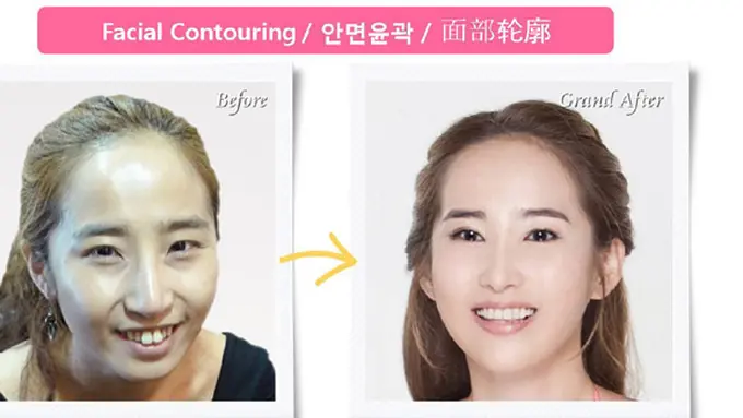 Foto: copyright grandplasticsurgery.blogspot.com