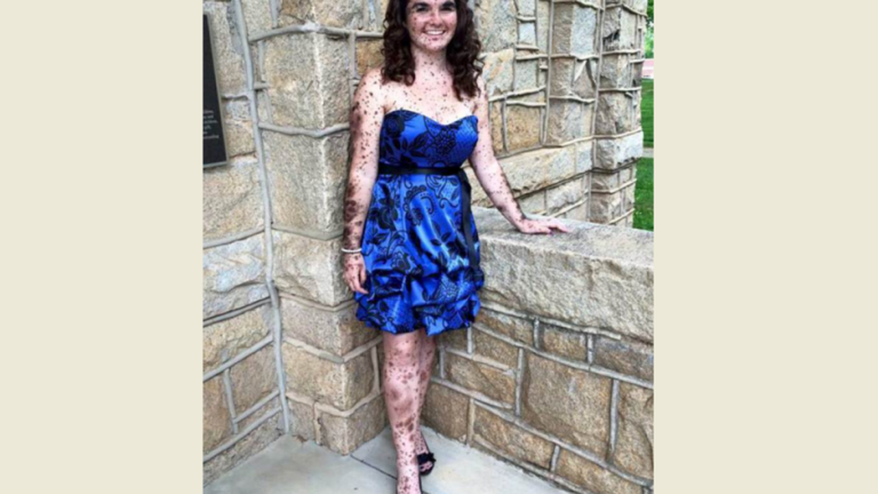 Tubuh Dipenuhi Tanda Lahir, Gadis Ini Berjuang Hadapi Ejekan