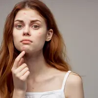 ilustrasi jerawat/ShotPrime Studio/shutterstock