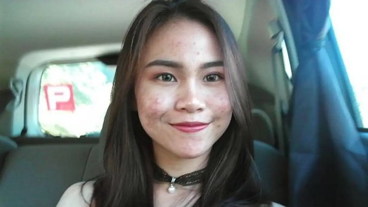 [Bintang] 6 Potret Selebgram yang Dibully Gara-gara Jerawat