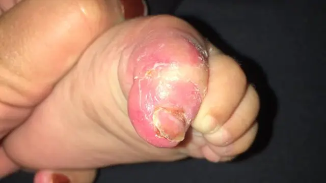 Akibat Dicium Sembarangan, Jari Kaki Bayi Menjadi Mengerikan