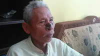 Digaruk, Tahi Lalat si Kakek Berubah Jadi Kanker