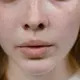 Hiperpigmentasi pasca inflamasi sering menjadi keluhan (Sumber: Pexels.com)