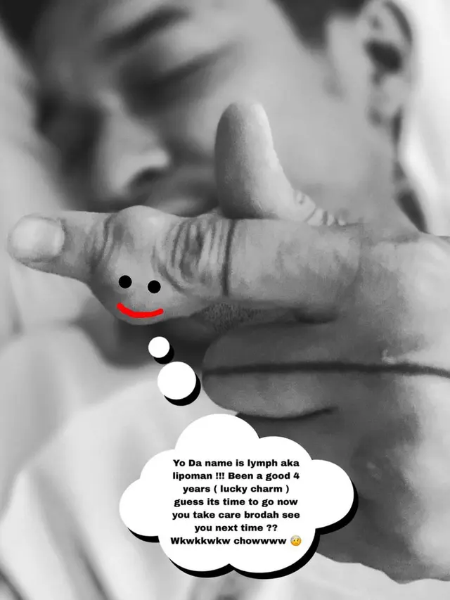 Miller Khan jalani operasi lipoma (Foto: Instagram/@miller_khan)