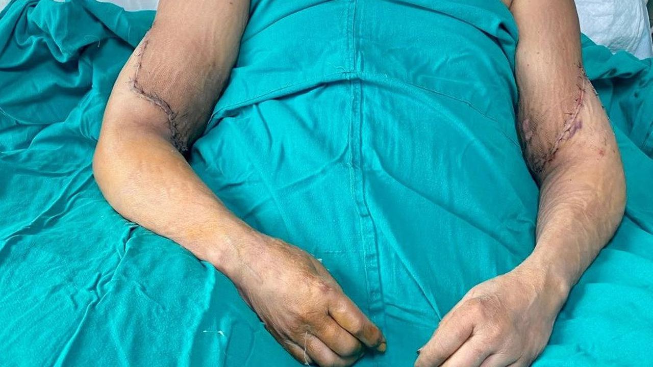 Transplantasi Dua Tangan