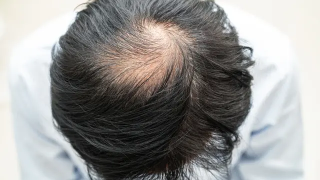 Rambut Menipis pada Pria, Apa Sih Penyebabnya? Waspadai Risiko Kebotakan, Temukan Solusinya!
