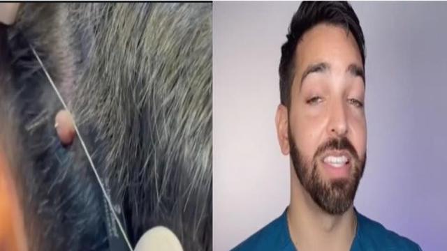 Viral, Tren TikTok Berbahaya Mengilangkan Tahi Lalat Dapat Kecaman Dokter