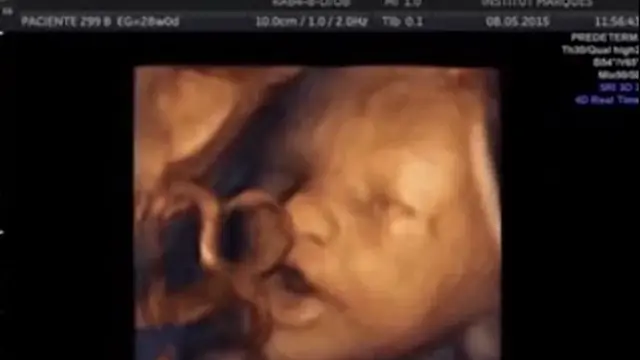 USG Aksi Menakjubkan Bayi Bernyanyi dalam Rahim