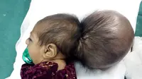 Sukses! Operasi Bayi Berkepala 2 di Afghanistan