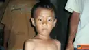 Citizen6, Cianjur: Seorang anak pengidap busung lapar di Kampung Cimariuk, Kecamatan Sinar Laut, Kabupaten Cianjur. (Pengirim: Reydani Sundani) 