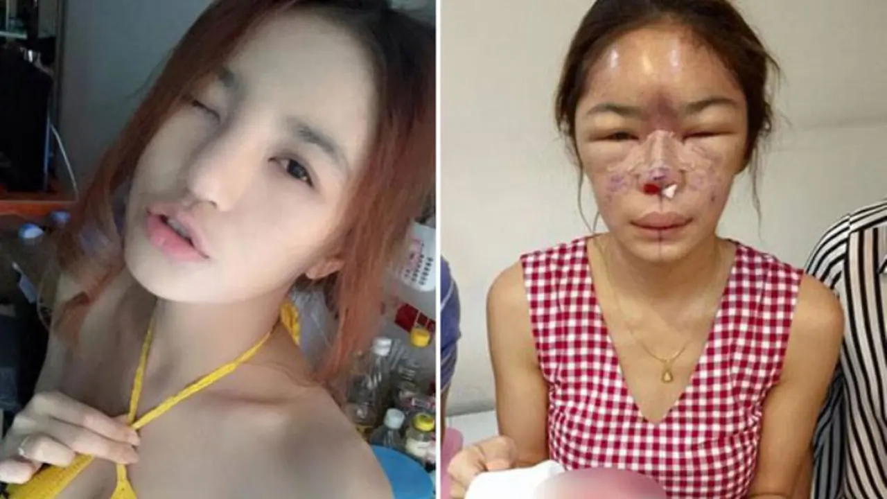 Ingin Cantik, Wajah Model Ini Malah Hancur Setelah Suntik Silikon