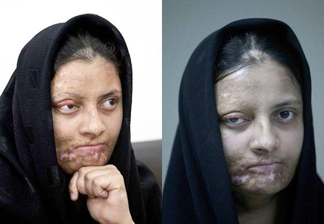 Asma Fayyaz, mengalami kecelakaan tercebur ke panci berisi lemak mendidih | foto: copyright dailymail.co.uk