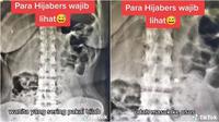 Wanita ini tak sengaja telan jarum pentul saat pakai hijab, benda itu tertancap di usus. (Sumber: TikTok/hanyafototulang)