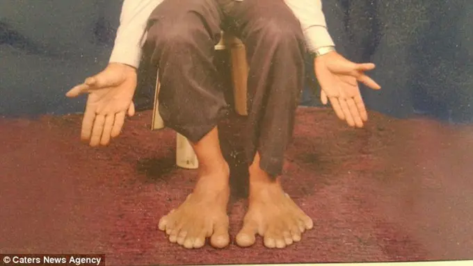 Punya 28 Jari, Laki-laki Ini Pecahkan Rekor Dunia