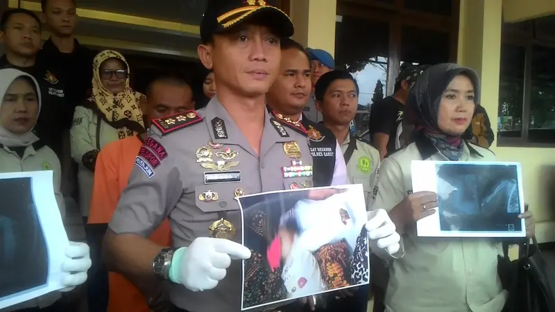 Kapolres Garut AKBP Budi Satria Wiguna menunjukan sejumlah hasil rontgen patahan tulang tangan bayi korban kekerasan di Garut