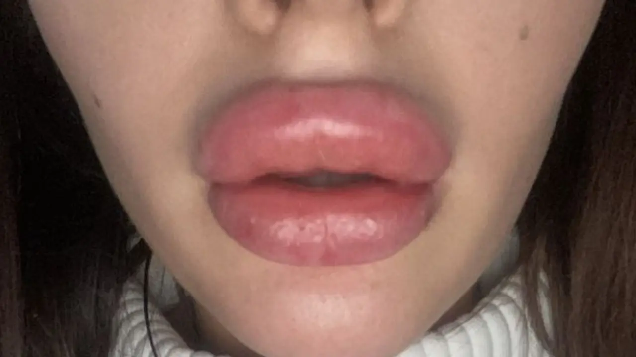 Lakukan Suntik Filler dengan Harga Murah, Bibir Wanita Ini Malah Bengkak Seperti Mau Meletus