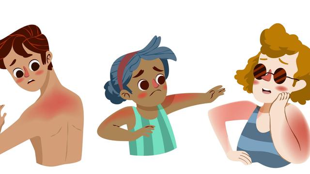 Ilustrasi sunburn, luka bakar akibat sinar matahari