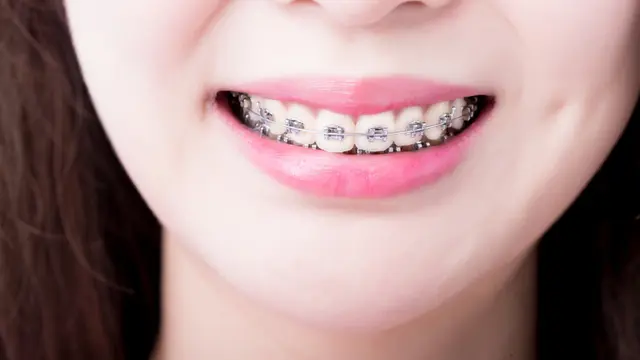 Batasan Usia Efektif Menggunakan Kawat Gigi (Aslysun/Shutterstock)