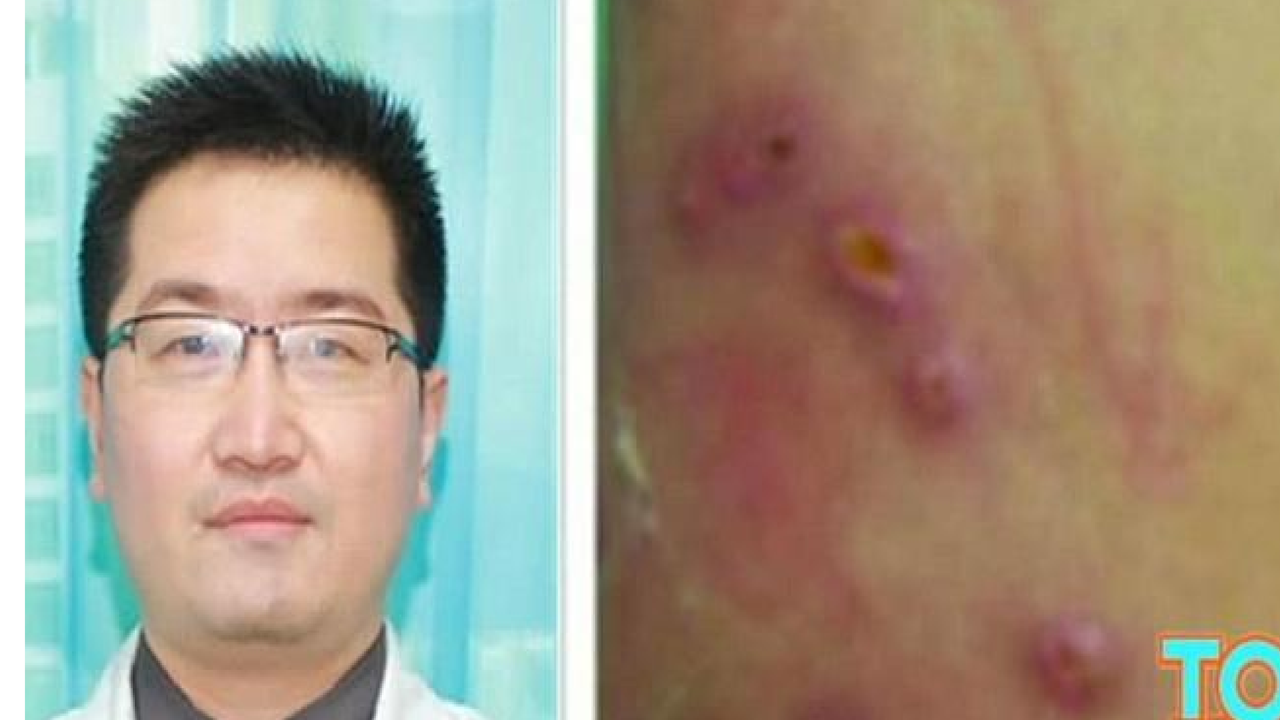 Belatung 'Bersarang' di Kulit Pria China Ini