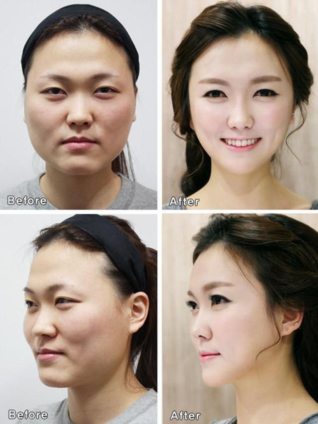 Contoh perubahan wajah setelah melakukan operasi plastik di Korea Selatan/copyright asiantown.net