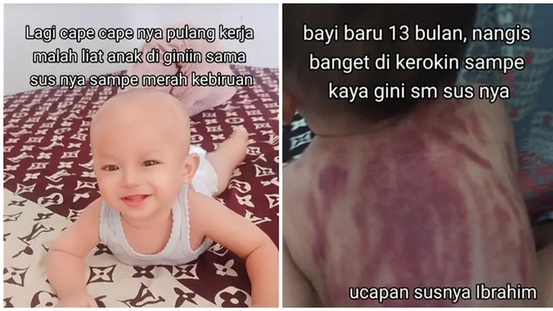 Viral Ibu Curhat Anaknya Berusia 13 Bulan Dikerok Baby Sitter, Netizen Ikut Kritik