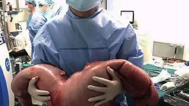 Dokter mengeluarkan kotoran dari usus besar pria China. (Shanghai Tenth People Hospital)