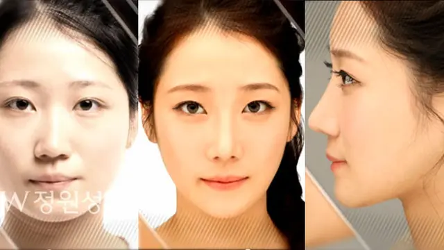 (c) JWplasticsurgeryKOR/youtube.com