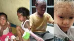 Ternyata kasus 'manusia bersisik' ditemukan di beberapa tempat. Berikut kasus beberapa orang yang memiliki kelainan kulit: (Istimewa) 