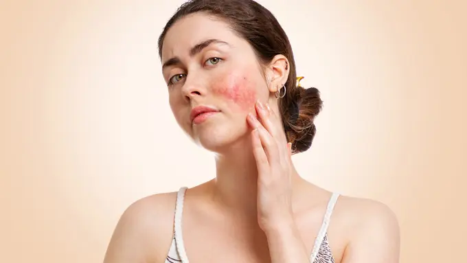 Bekas Jerawat Kemerahaan? Klinik Kecantikan Ini Tawarkan Solusi yang Bikin Kulitmu Mulus Kembali