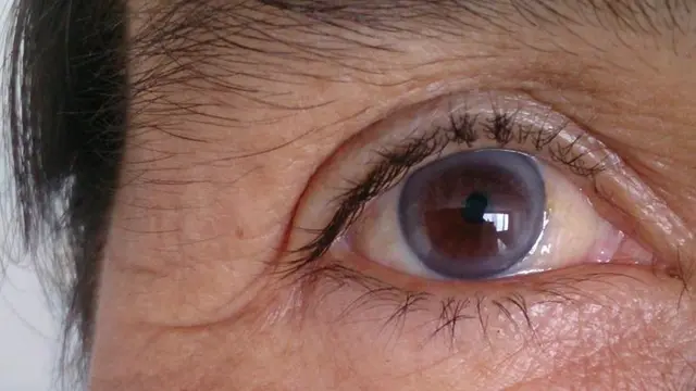 Arcus Senilis. (foto: Pinterest/Medical News Today).