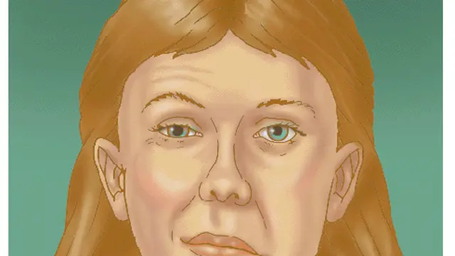 Penyakit Bell's Palsy