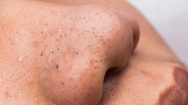 Hilangkan Komedo dengan 4 Bahan Alami Ini