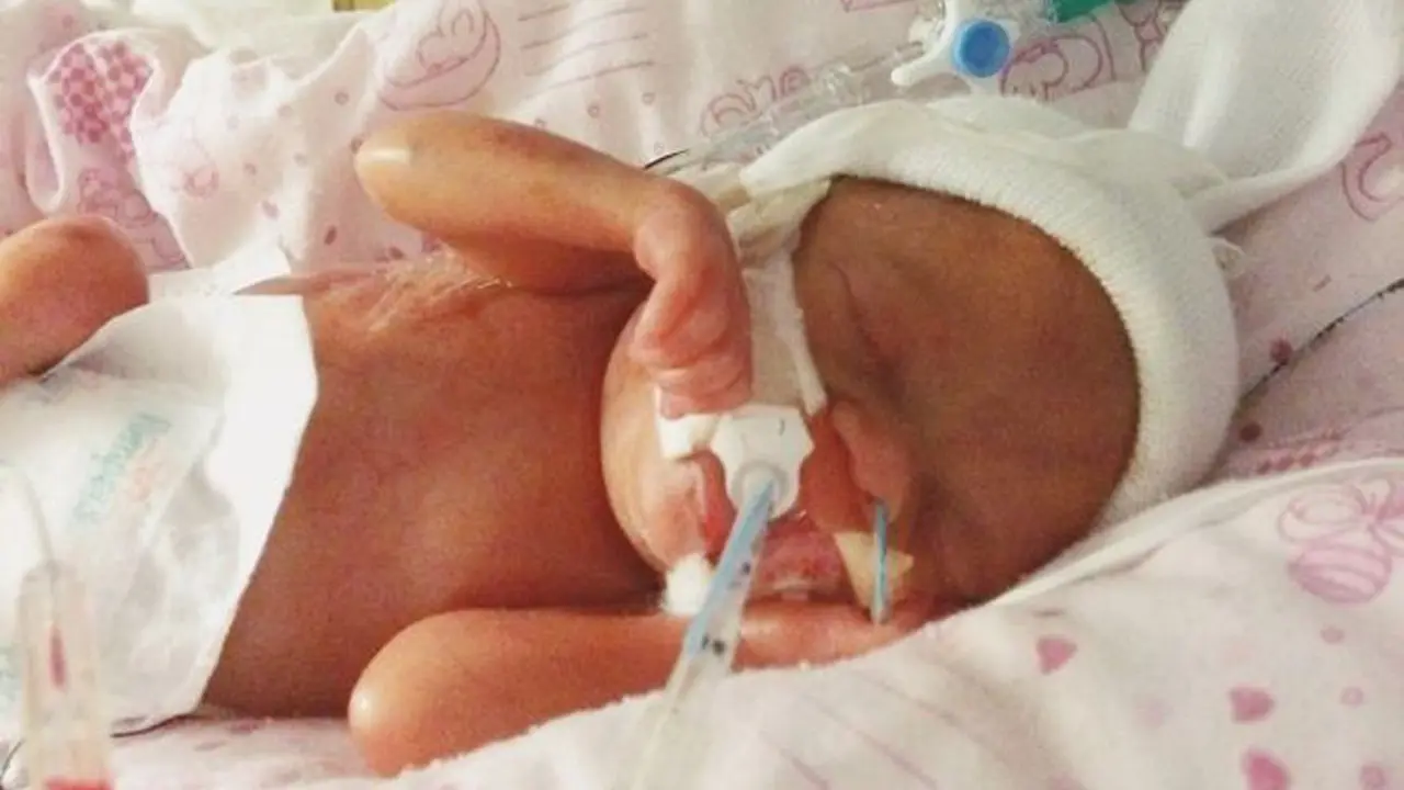 Lahir Prematur, Bayi Ini Lahir Hanya Seukuran Gelas Bir