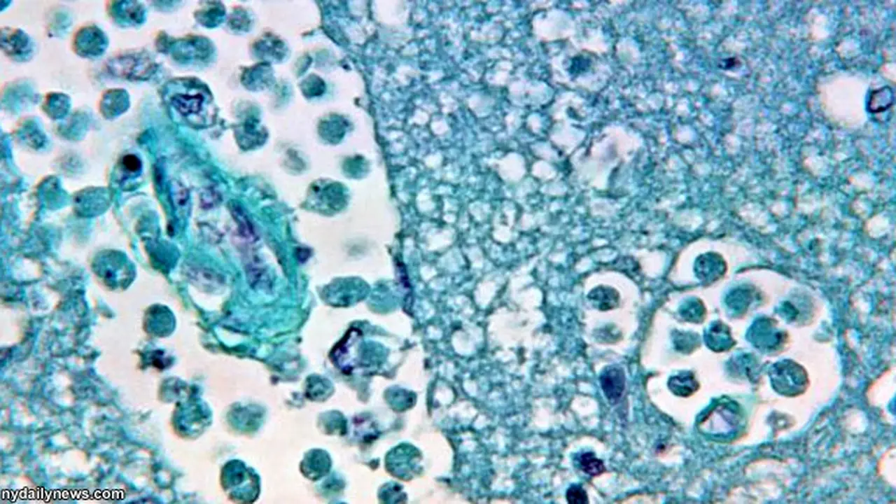 infeksi-amoeba-130828b.jpg