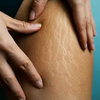 Ilustrasi stretch mark/Shutterstock-Yanya.