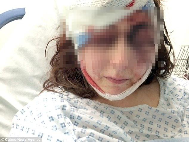 Akibat serangan yang dilakukan Ress, Hayles mengalami luka memar dan bengkak di wajah | Photo: Copyright dailymail.co.uk