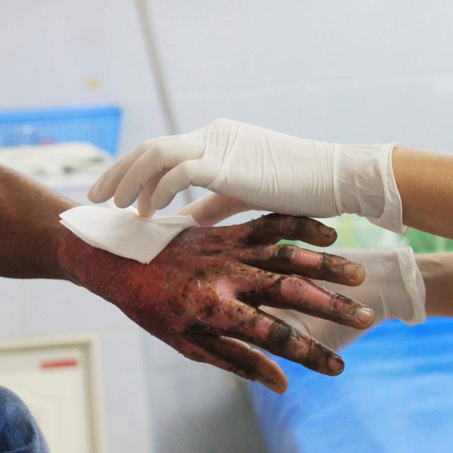 Langkah Langkah Pertama Untuk Atasi Luka Bakar Ringan Dan