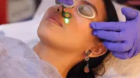 Beauty Info: Laser Wajah untuk Hilangkah Jerawat