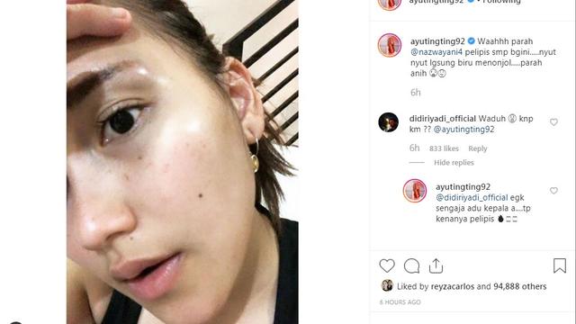 Pelipis Bengkak Ayu Ting Ting Dapat Perhatian Dari Didi Riyadi Showbiz Liputan6 Com