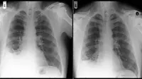 Miniatur traffic cone tertelan di paru-paru Paul dan sudah 40 tahun lamanya di paru-paru. (Foto: Biomedical Journal Case Reports)