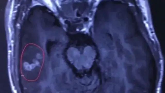 Derita Epilepsi, Ternyata Ada Cacing Pita di Otak Pria Ini